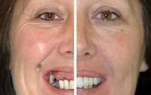 Full Mouth Rehabilitation Implants London