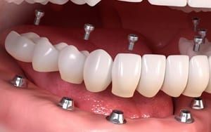 Full Mouth Dental Implant London
