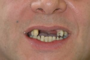 Front Teeth Dental Implants Before
