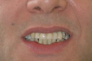 Front Teeth Dental Implants After