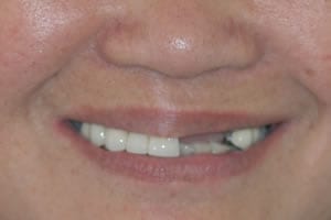 Missing Teeth Dental Implant Before